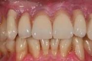 Физиологическая подвижность зубов