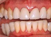 Протезирование зубов металлокерамическими коронками