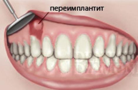 Чем вызвана боль после имплантации зуба?