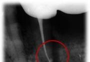 Почему болит зуб после удаления нерва: причины, последствия