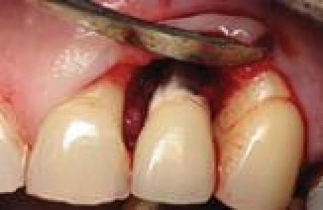 Осложнения после протезирования зубного импланта коронками: периимплантит и отторжение импланта