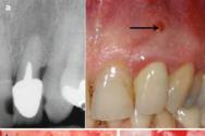 Особенности кариеса корня зуба и его лечение